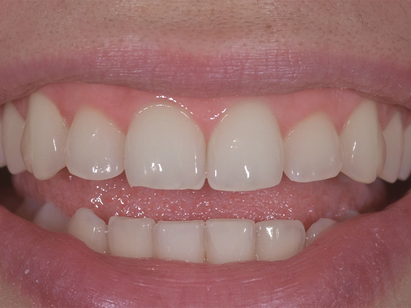 Rezultati izbjeljivanja zubi, primjer 1