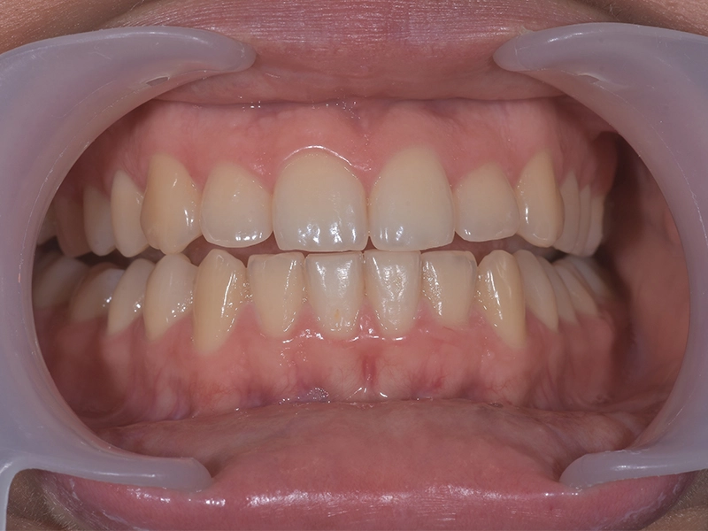 Izbjeljivanje zubi, slika prije, primjer 1