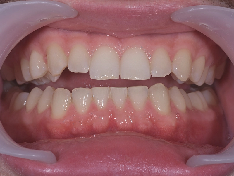 Rezultati izbjeljivanja zubi, primjer 2