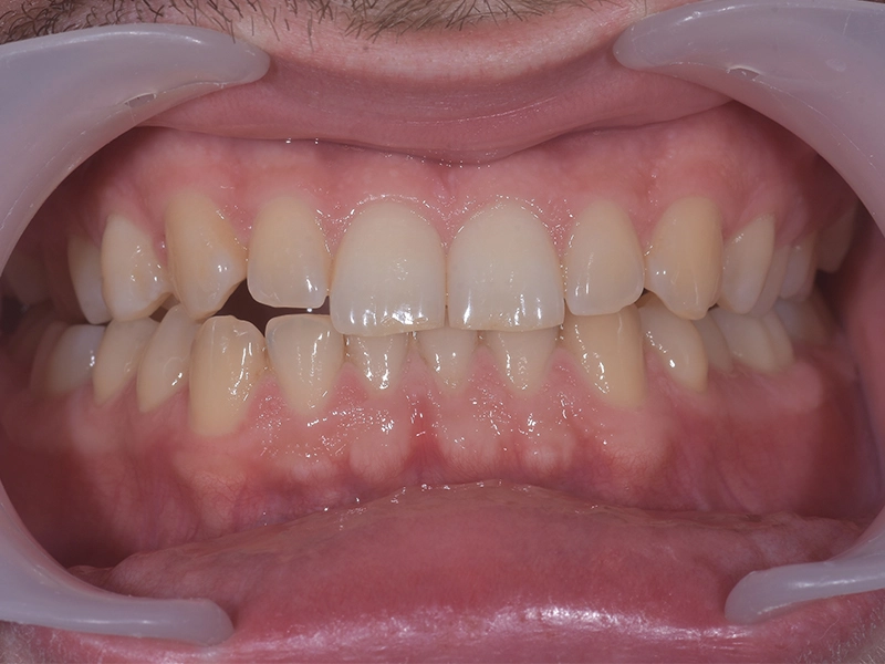 Izbjeljivanje zubi, slika prije, primjer 2